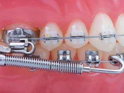 Functional orthodontics