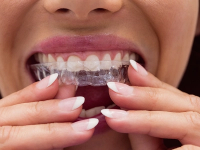 Invisible orthodontics