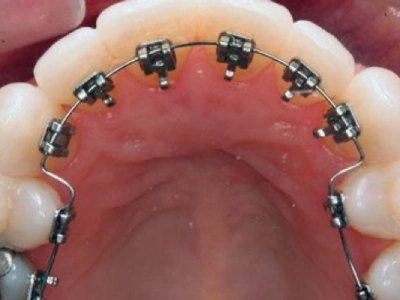 Lingual Orthodontics