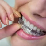 ارتودنسی نامرئی چیست؟ بررسی مزایا و معایب این روش